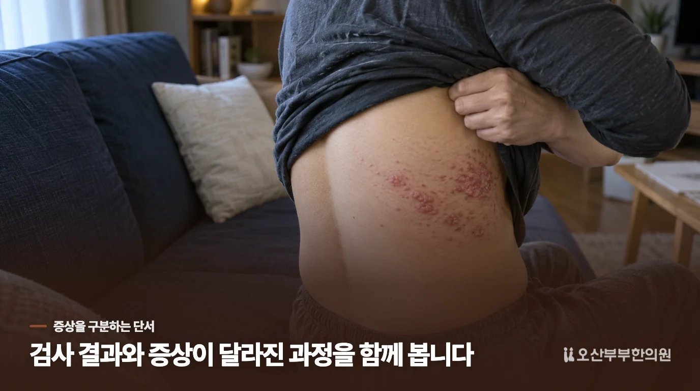 물집이 없다고 대상포진을 바로 지울 수는 없습니다