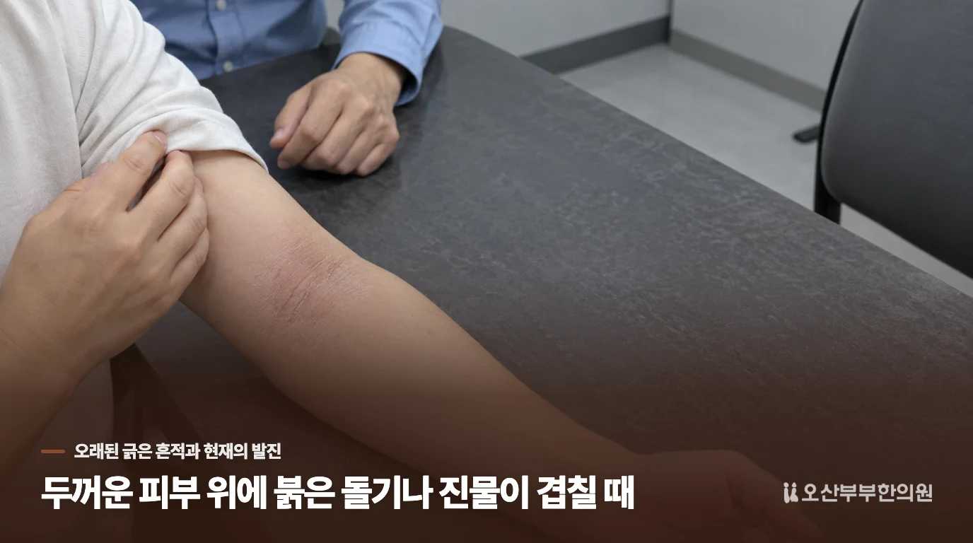 두꺼운 피부 위에 붉은 돌기나 진물이 겹칠 때