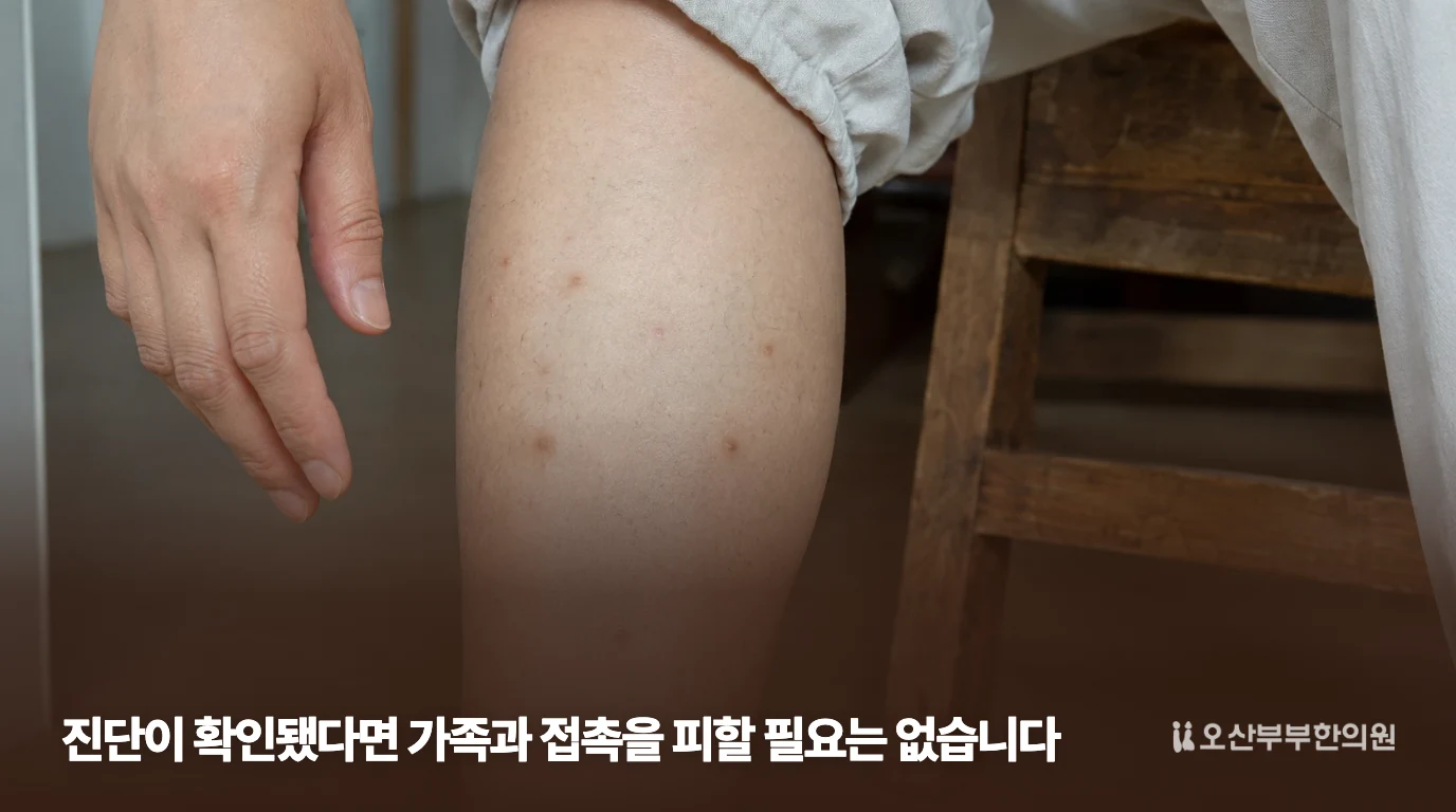 피부에 단단한 돌기가 보이는 결절성양진 설명 이미지