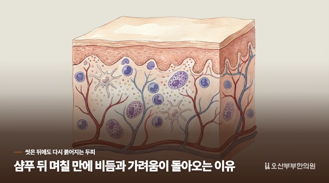 샴푸 뒤 며칠 만에 비듬과 가려움이 돌아오는 이유