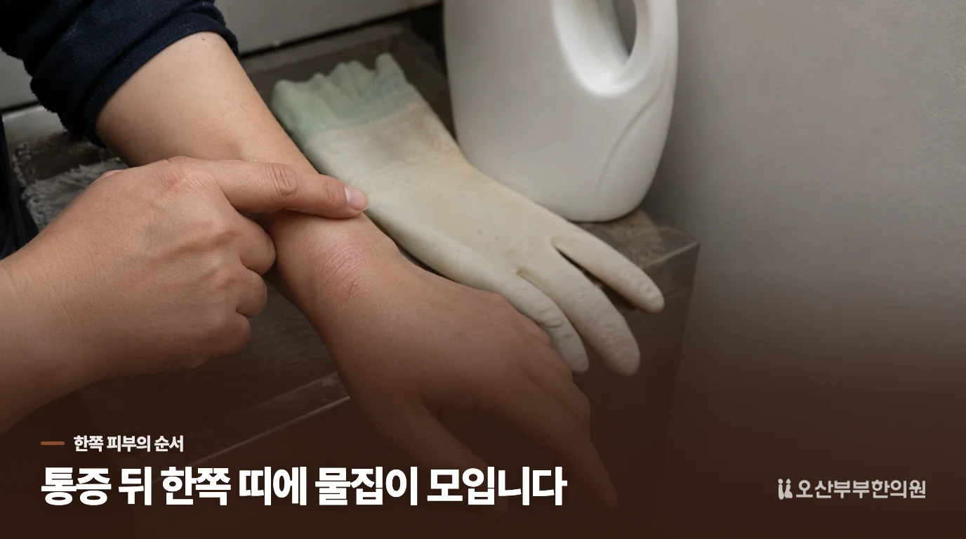 통증이 먼저 생기고 한쪽에 물집이 모이면 대상포진을 의심합니다