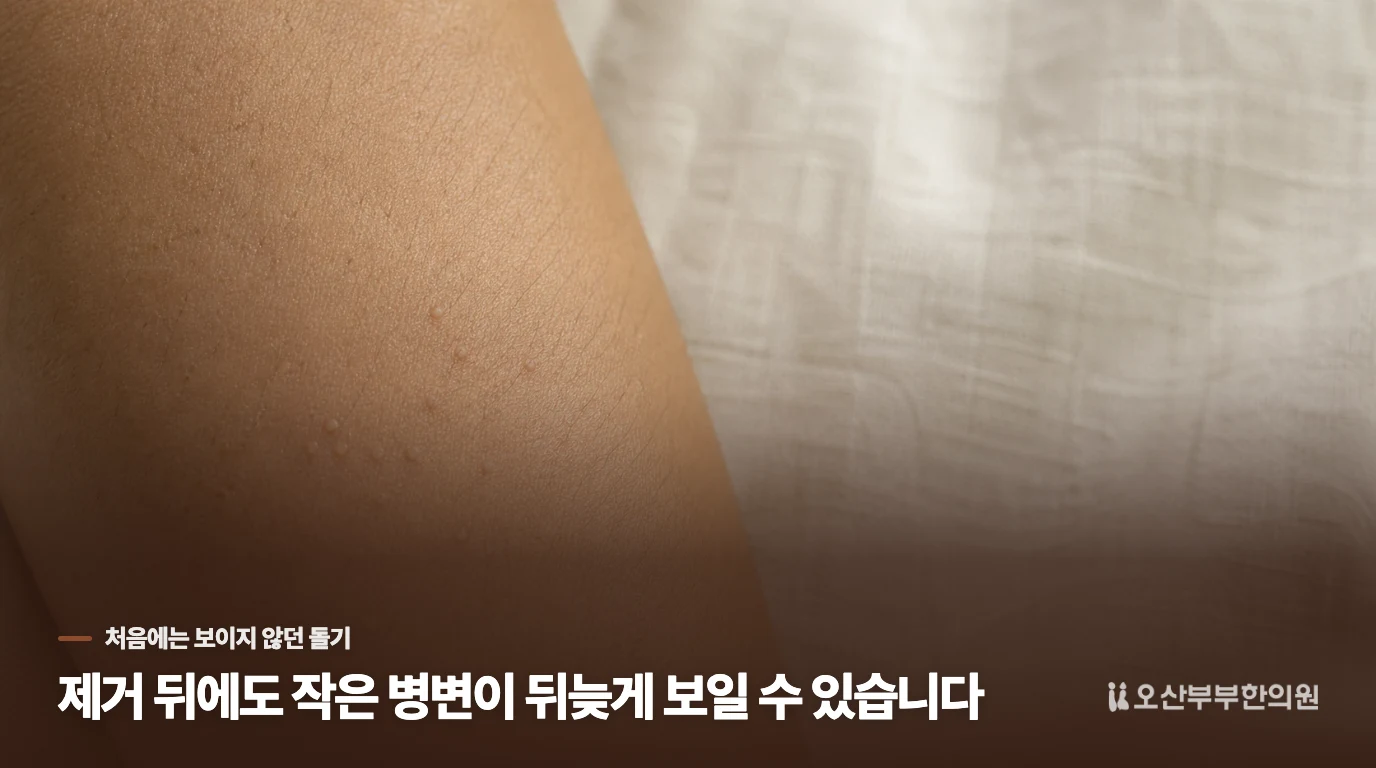 제거 뒤에도 작은 병변이 뒤늦게 보일 수 있습니다