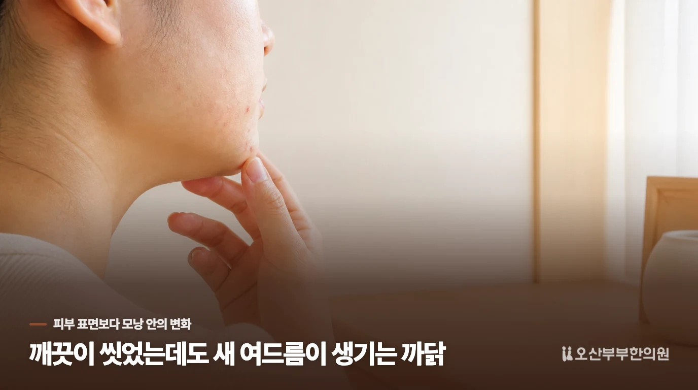 깨끗이 씻었는데도 새 여드름이 생기는 까닭